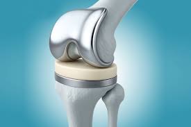 knee replacement malaysia
