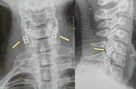 transplantasi sumsum tulang belakang