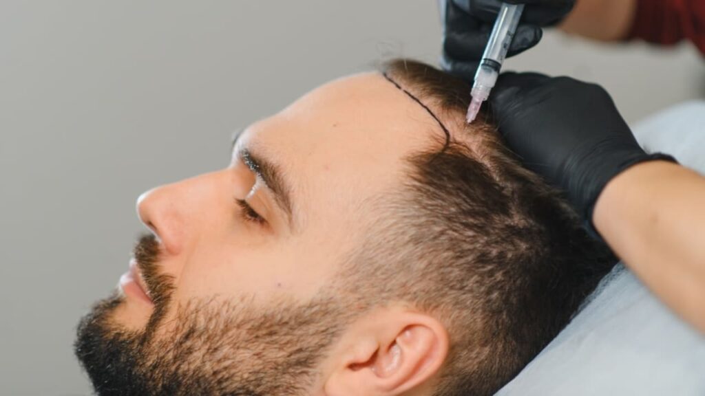 transplantasi rambut