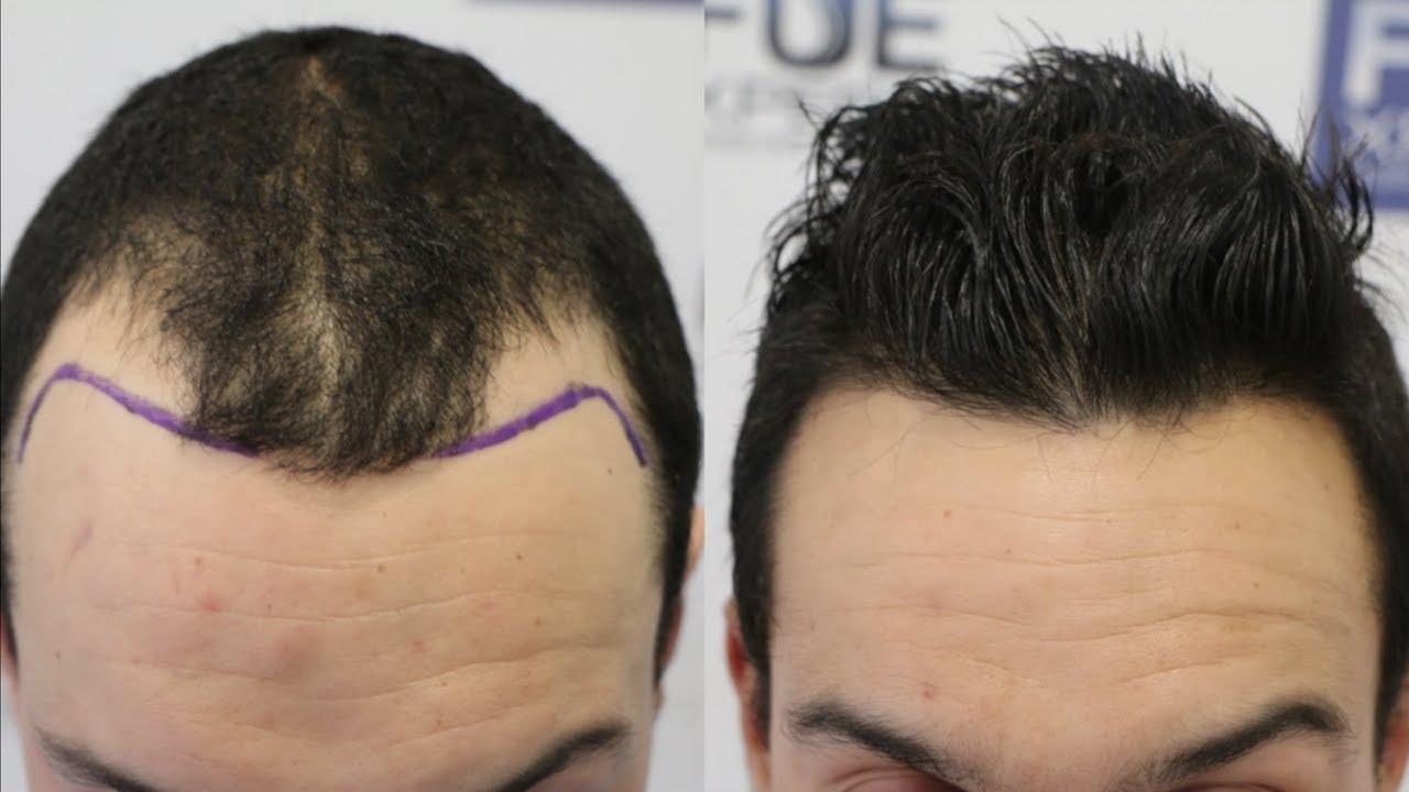 transplantasi rambut turki